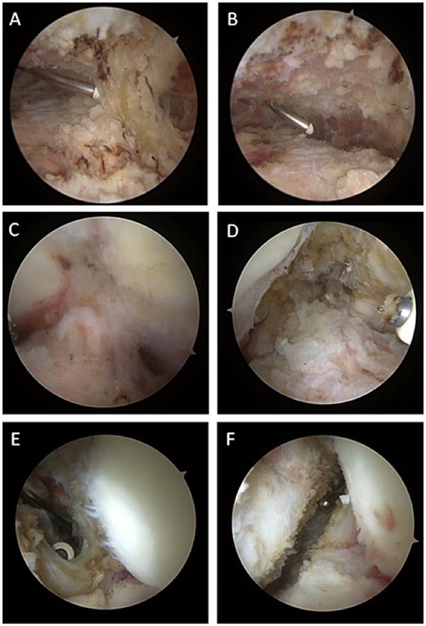 Arthrofibrosis Nightmares: Prevention and Management Strategies.