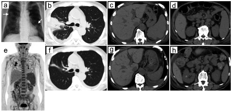 Glucocorticoid-induced redistribution lymphocytosis in mantle cell lymphoma with hyaline vascular Castleman disease-like features.