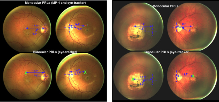 Binocular visual function and fixational control in patients with macular disease: A review.