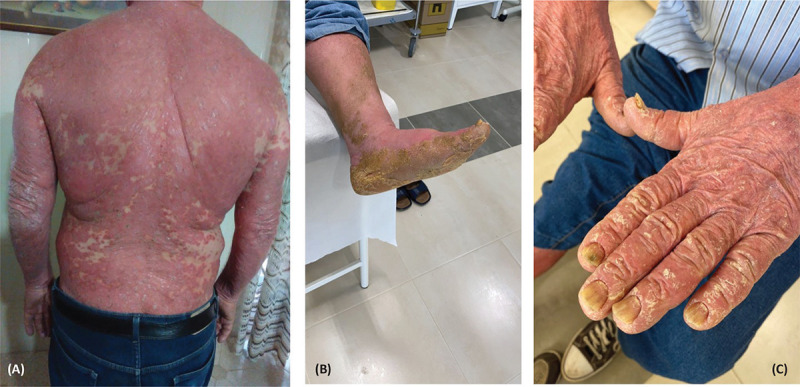 Erythrodermic psoriasis and palmoplantar hyperkeratosis successfully treated with secukinumab: a case report.