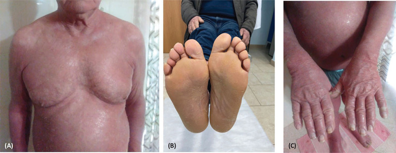 Erythrodermic psoriasis and palmoplantar hyperkeratosis successfully treated with secukinumab: a case report.
