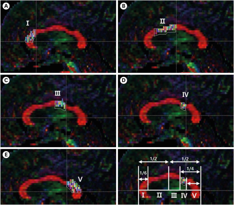 Relationship Between Ipsilesional Upper Extremity Motor Function and Corpus Callosum Integrity in Patients With Unilateral Stroke: A Diffusion Tensor Imaging Study.