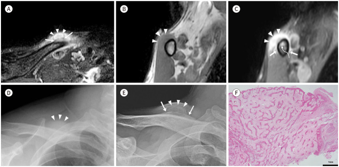 Florid Reactive Periostitis of the Clavicle: A Case Report.