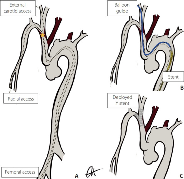 Y Stent Rendezvous to Treat Symptomatic Innominate Artery Stenosis.