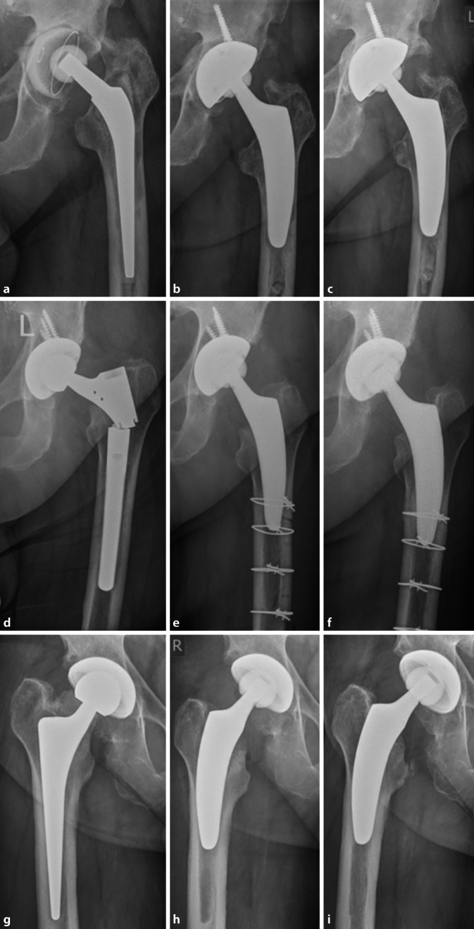 Downsizing in total hip arthroplasty. A short stem as a revision implant.