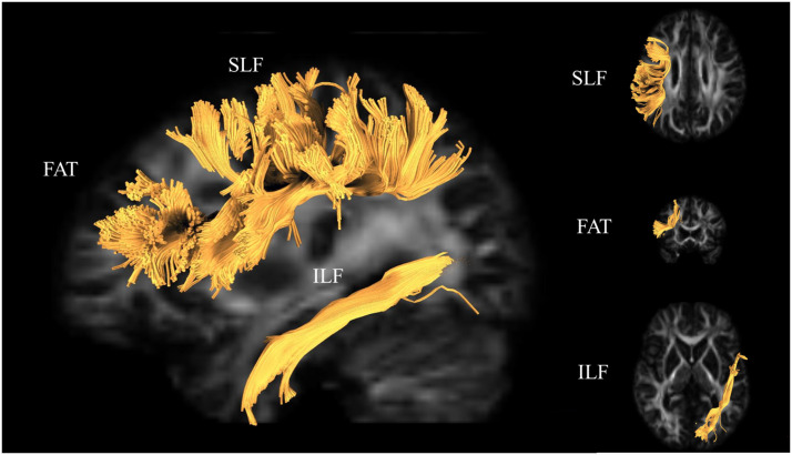 Cerebral White Matter Mediation of Age-Related Differences in Picture Naming Across Adulthood.