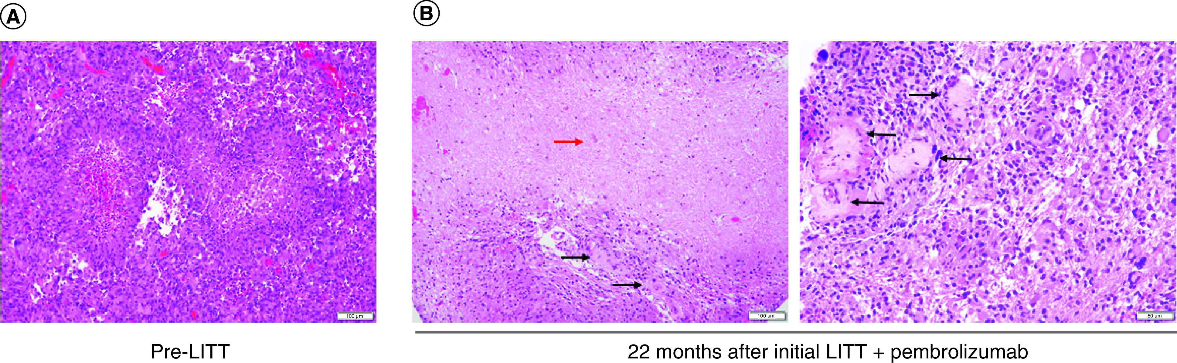 Prolonged response of recurrent <i>IDH</i>-wild-type glioblastoma to laser interstitial thermal therapy with pembrolizumab.