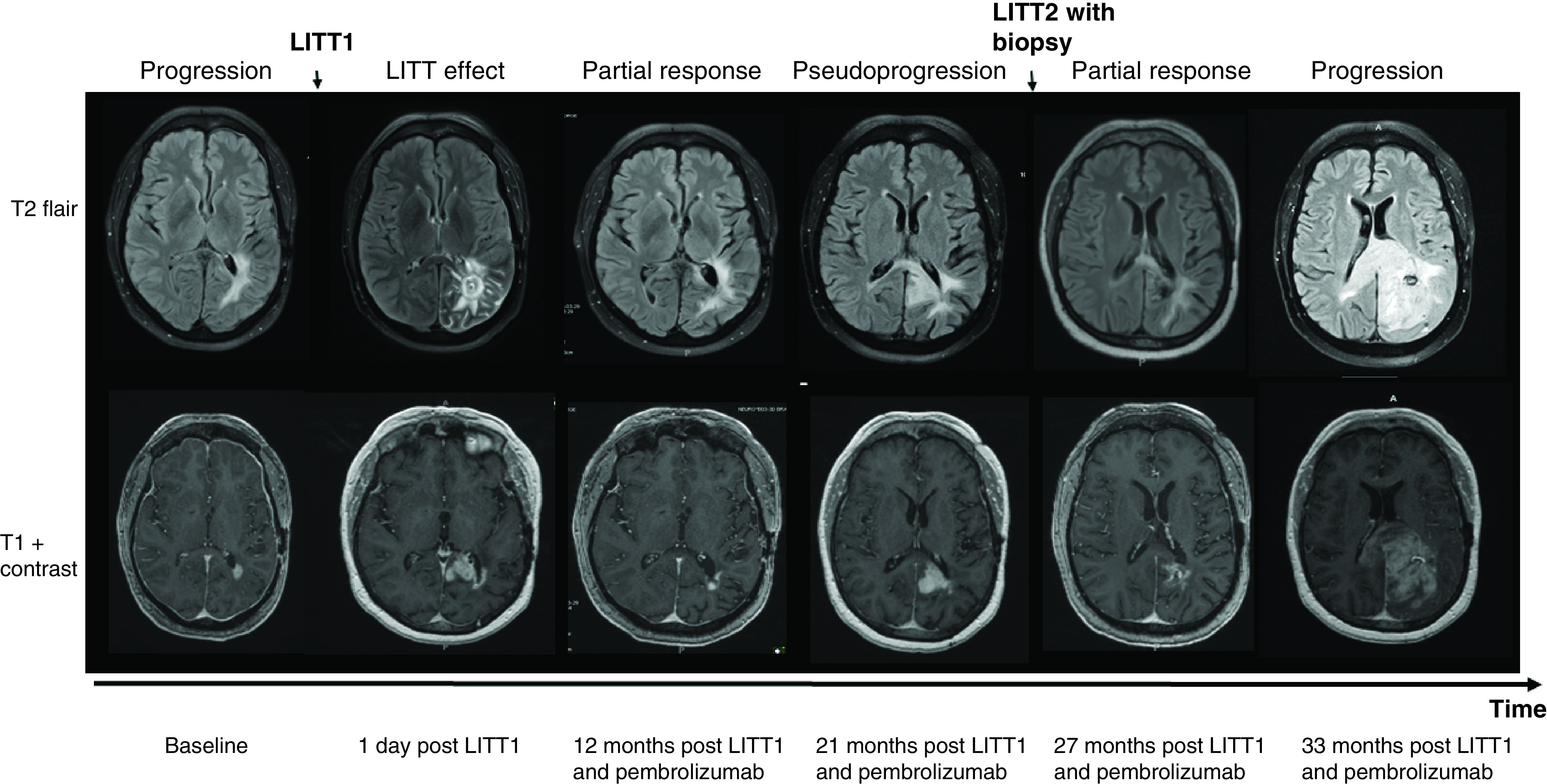 Prolonged response of recurrent <i>IDH</i>-wild-type glioblastoma to laser interstitial thermal therapy with pembrolizumab.