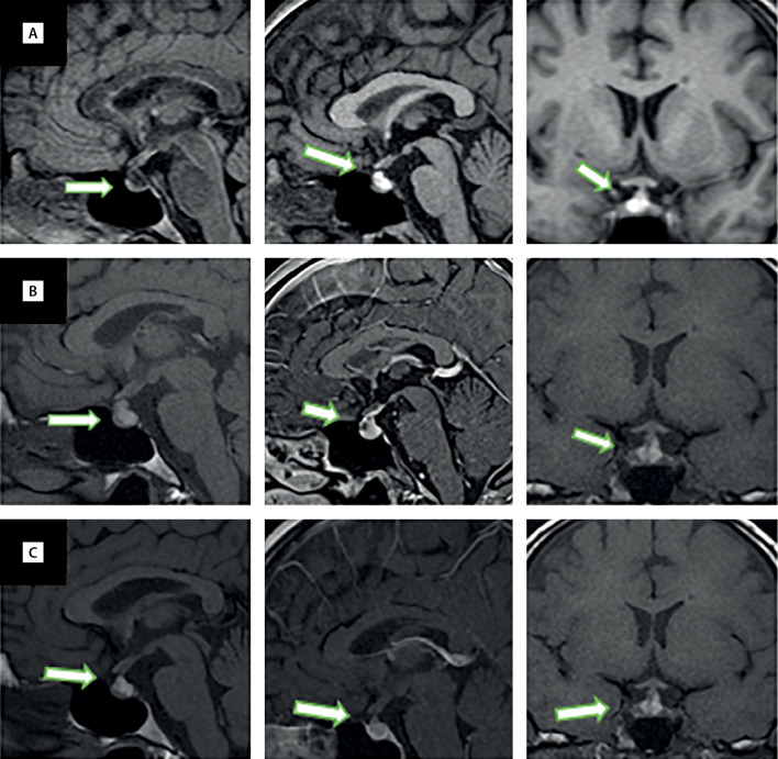 [Hypophysitis and reversible hypopituitarism developed after COVID-19 infection - a clinical case report].