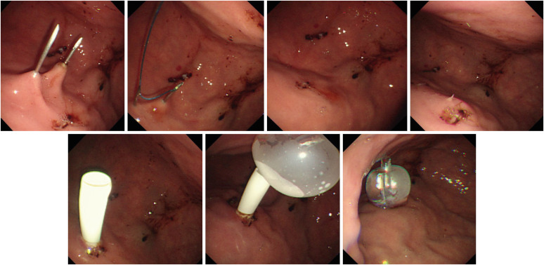 Percutaneous Endoscopic Gastrostomy: Procedure, Complications and Management.