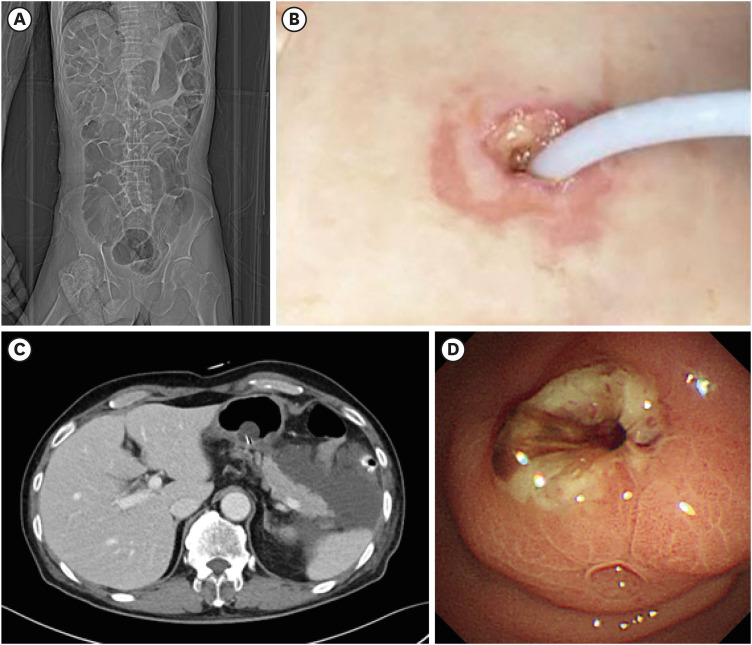 Percutaneous Endoscopic Gastrostomy: Procedure, Complications and Management.