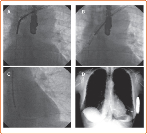 Arrhythmias in Chronic Kidney Disease.