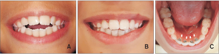 Evaluation of periodontal parameters and gingival crevicular fluid cytokines in children with anterior open bite receiving passive orthodontic treatment with a spur.