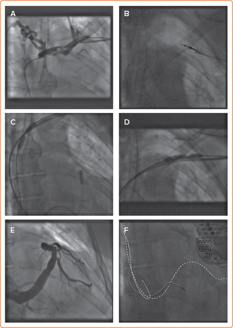 Arrhythmias in Chronic Kidney Disease.