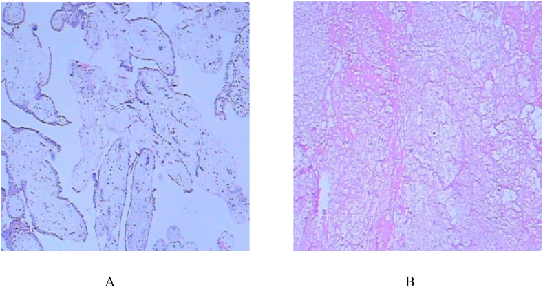 Uterine artery embolization combined with ultrasound-guided dilation and curettage for the treatment of cesarean scar pregnancy: Efficacy and 5–8-year follow-up study