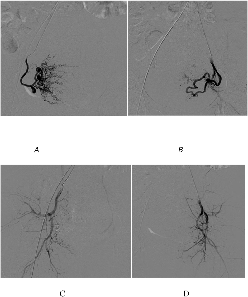 Uterine artery embolization combined with ultrasound-guided dilation and curettage for the treatment of cesarean scar pregnancy: Efficacy and 5–8-year follow-up study