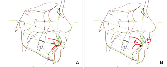 Evaluation of periodontal parameters and gingival crevicular fluid cytokines in children with anterior open bite receiving passive orthodontic treatment with a spur.