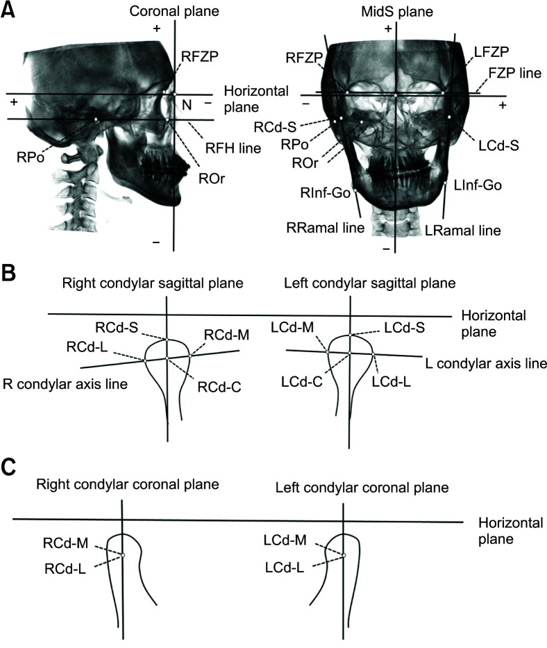 Characterization of facial asymmetry phenotypes in adult patients with skeletal Class III malocclusion using three-dimensional computed tomography and cluster analysis.