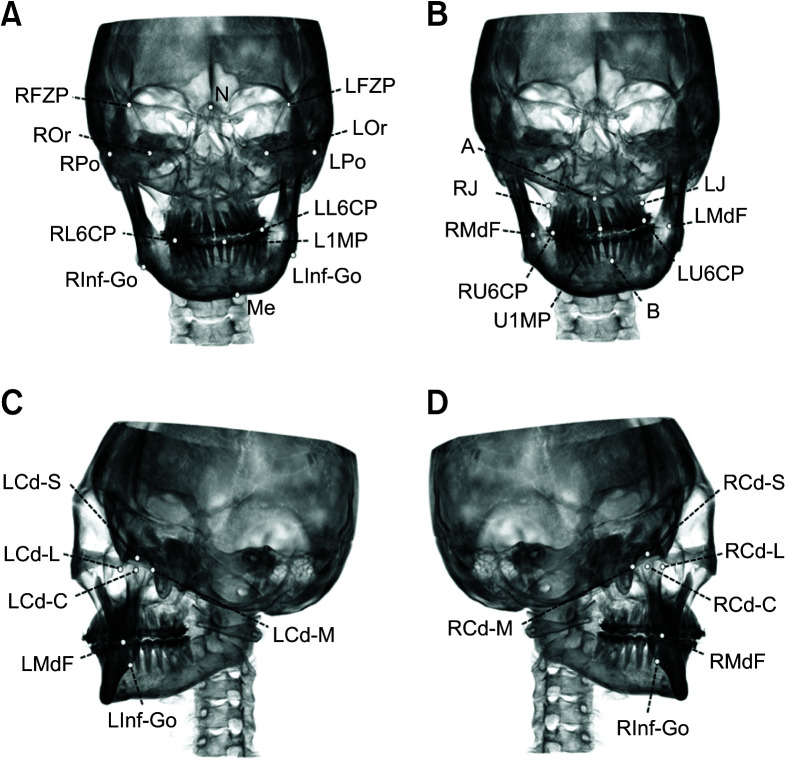 Characterization of facial asymmetry phenotypes in adult patients with skeletal Class III malocclusion using three-dimensional computed tomography and cluster analysis.