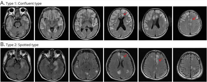 MRI Characteristics of Autoimmune Encephalitis With Autoantibodies to GABAA Receptor: A Case Series.
