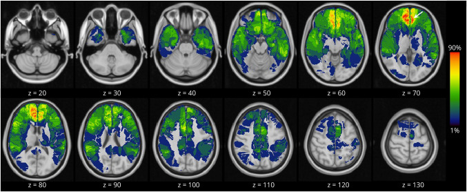 MRI Characteristics of Autoimmune Encephalitis With Autoantibodies to GABAA Receptor: A Case Series.