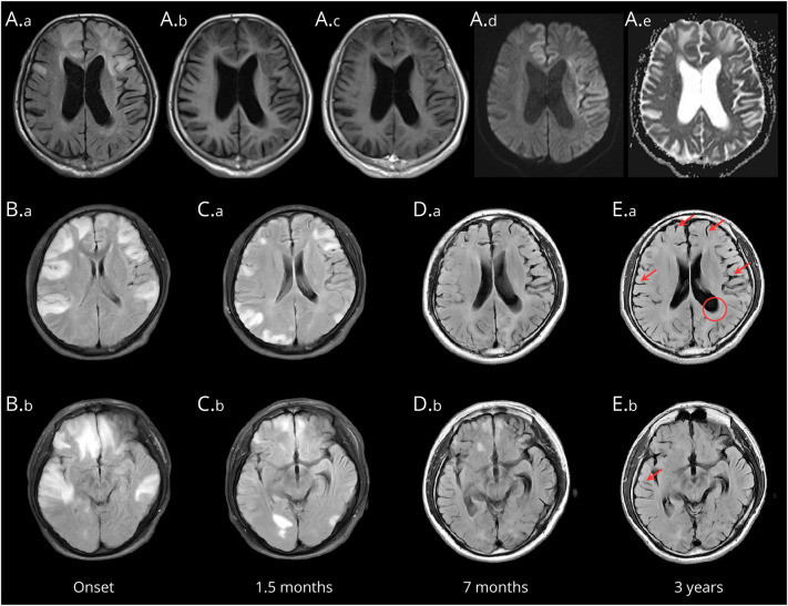 MRI Characteristics of Autoimmune Encephalitis With Autoantibodies to GABAA Receptor: A Case Series.
