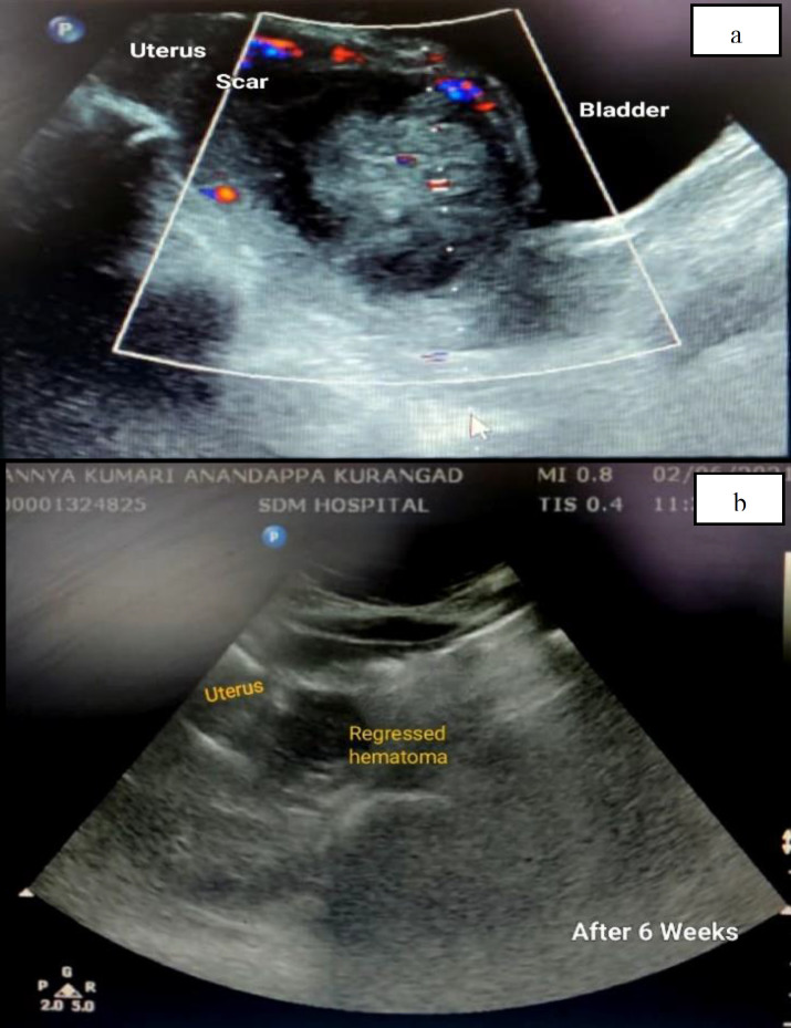 Interventional Challenges in Non-Tubal Ectopic Pregnancy.