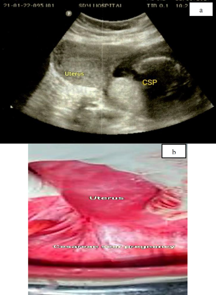 Interventional Challenges in Non-Tubal Ectopic Pregnancy.