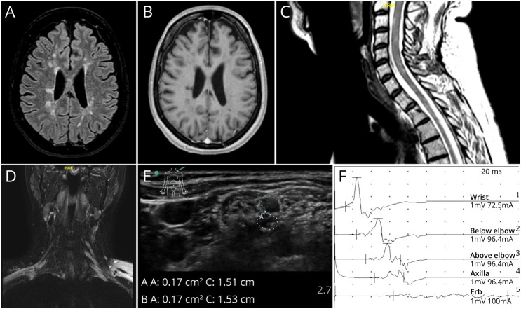 Combined Central and Peripheral Demyelination With IgM Anti-Neurofascin 155 Antibodies: Case Report.