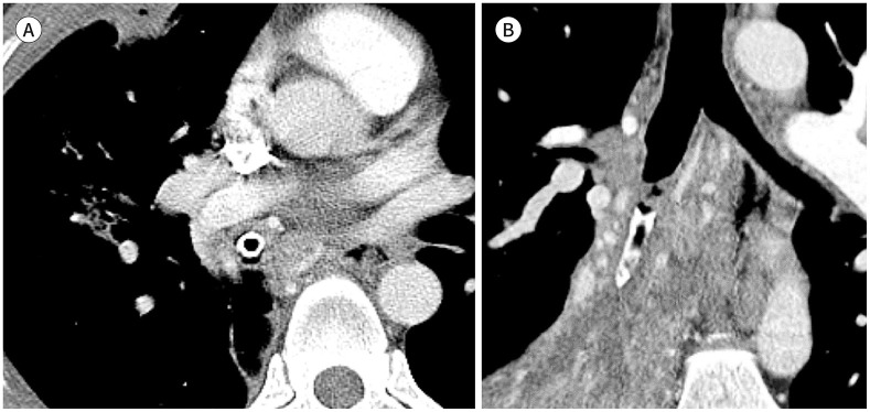 A Pictorial Review of Radiologic Findings of Foreign Bodies in the Thorax.