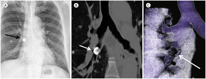 A Pictorial Review of Radiologic Findings of Foreign Bodies in the Thorax.