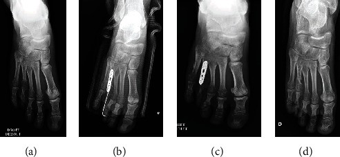 Brachymetatarsia: Surgical Management, Case Report, and Literature Review.
