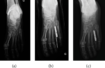 Brachymetatarsia: Surgical Management, Case Report, and Literature Review.