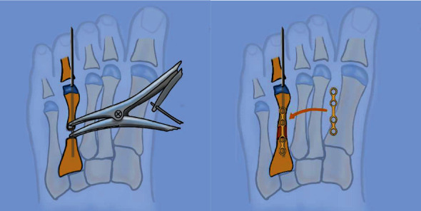 Brachymetatarsia: Surgical Management, Case Report, and Literature Review.