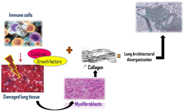 Physiopathological Mechanisms Involved in the Progression of Pulmonary Fibrosis: A Systematic Review.