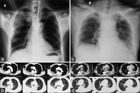 Melioidosis Presenting Predominantly as Thoracic Empyema.