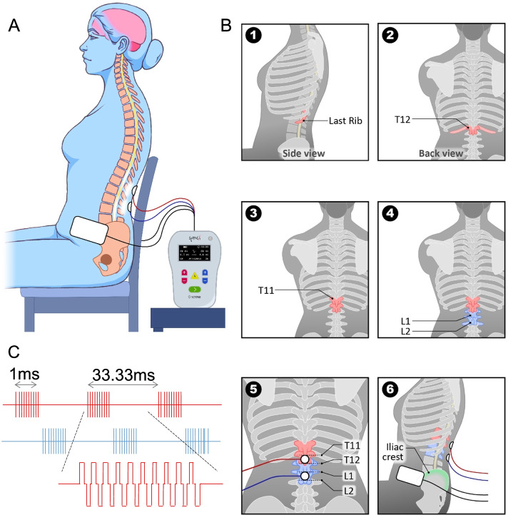 Noninvasive spinal neuromodulation mitigates symptoms of idiopathic overactive bladder.