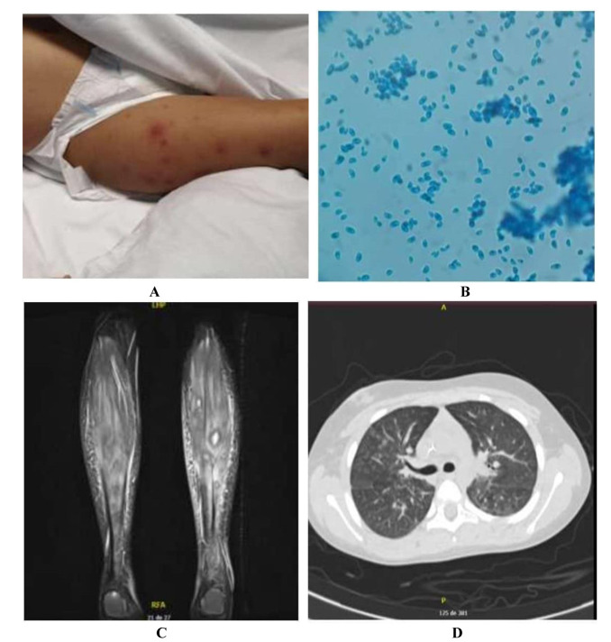 Disseminated fusariosis in children: Report of two cases in girls with leukemia.