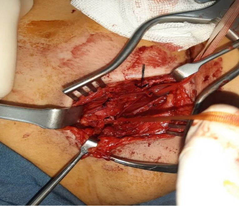 Management of iliofemoral vein injury during open inguinal hernia repair.