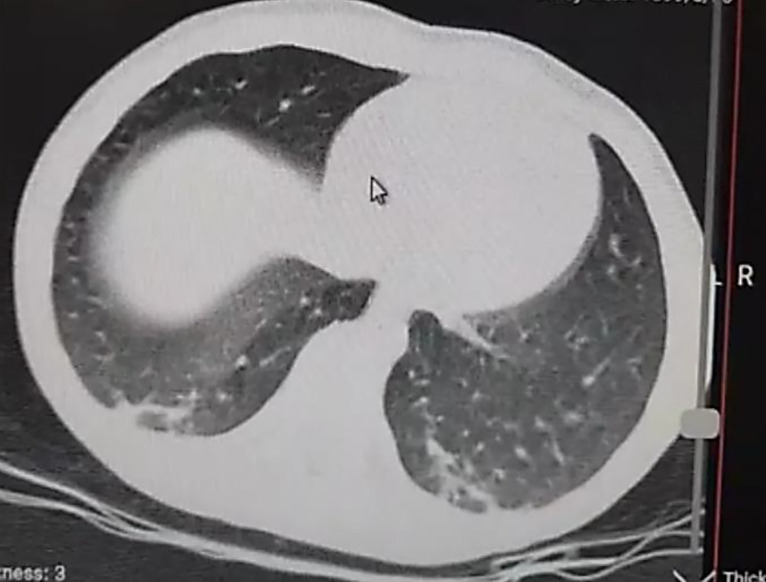 Management of iliofemoral vein injury during open inguinal hernia repair.