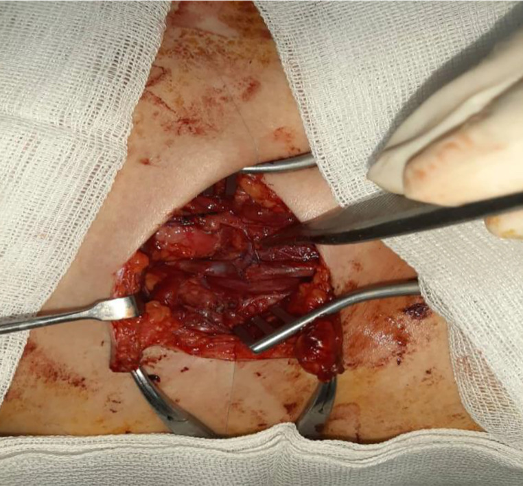 Management of iliofemoral vein injury during open inguinal hernia repair.