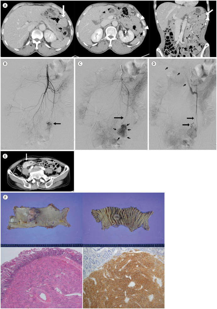 Identifying Small Bowel Gastrointestinal Stromal Tumor as the Culprit Lesion in Obscure Gastrointestinal Bleeding: Emphasis on Angiographic Findings.