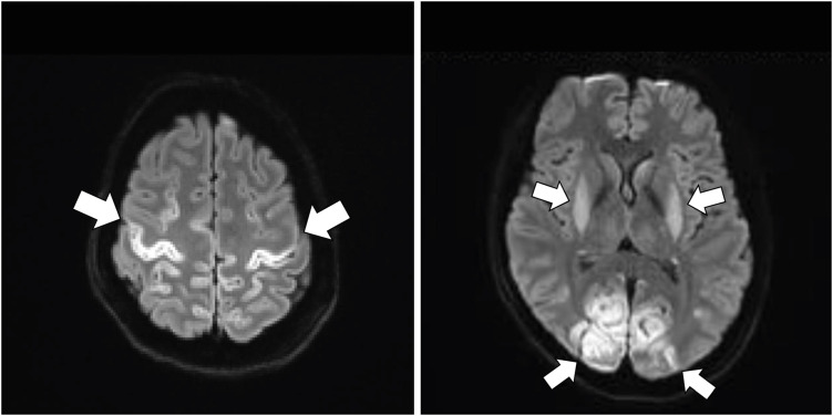 Successful Control of Intractable Myoclonus in a Patient With Hypoxic Brain Injury After Intrathecal Baclofen Therapy: A Case Report.