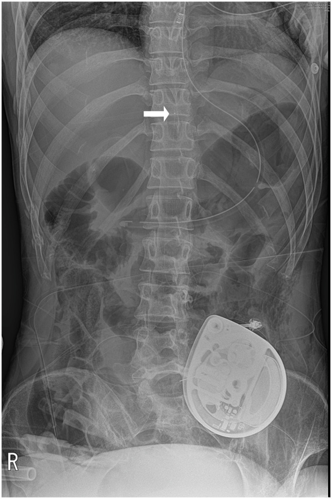 Successful Control of Intractable Myoclonus in a Patient With Hypoxic Brain Injury After Intrathecal Baclofen Therapy: A Case Report.