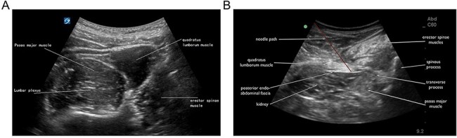 Comparative efficacy analysis of ultrasound-guided quadratus lumborum block and lumbar plexus block in hip arthroscopy: a pilot prospective randomized controlled trial.