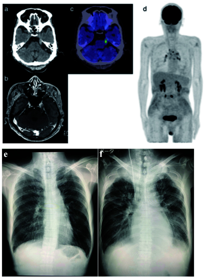 Rapid deterioration of intravascular large B-cell lymphoma with mass formation in the trigeminal nerve and multiple organ infiltration: An autopsy case report.