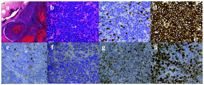 Rapid deterioration of intravascular large B-cell lymphoma with mass formation in the trigeminal nerve and multiple organ infiltration: An autopsy case report.