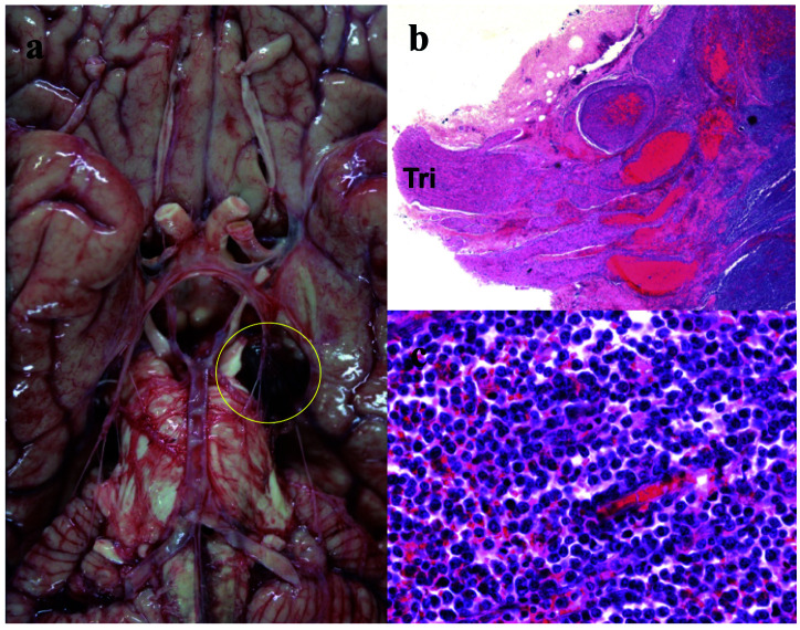 Rapid deterioration of intravascular large B-cell lymphoma with mass formation in the trigeminal nerve and multiple organ infiltration: An autopsy case report.