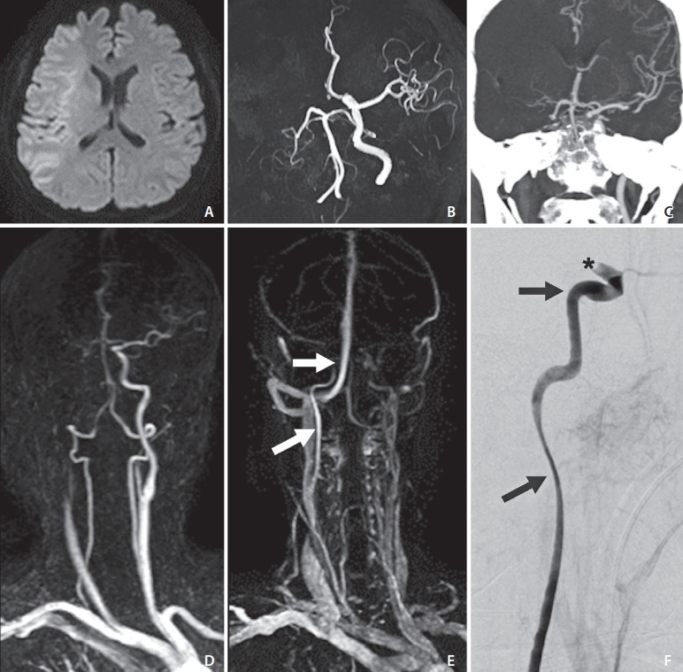 Imaging in Acute Anterior Circulation Ischemic Stroke: Current and Future.