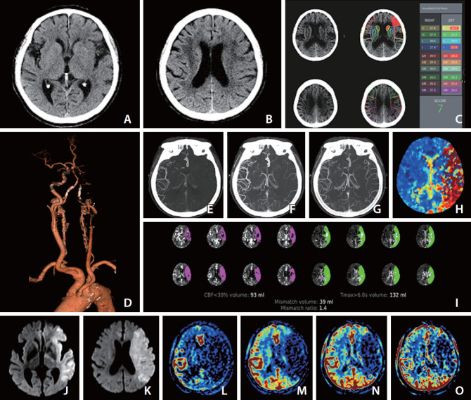 Imaging in Acute Anterior Circulation Ischemic Stroke: Current and Future.